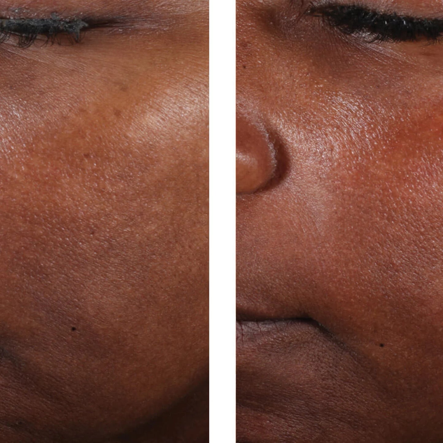 Close-up before-and-after style comparison of a person's facial skin, showing a side-by-side view of the cheek, nose, and mouth area with smoother, brighter skin on the right side.