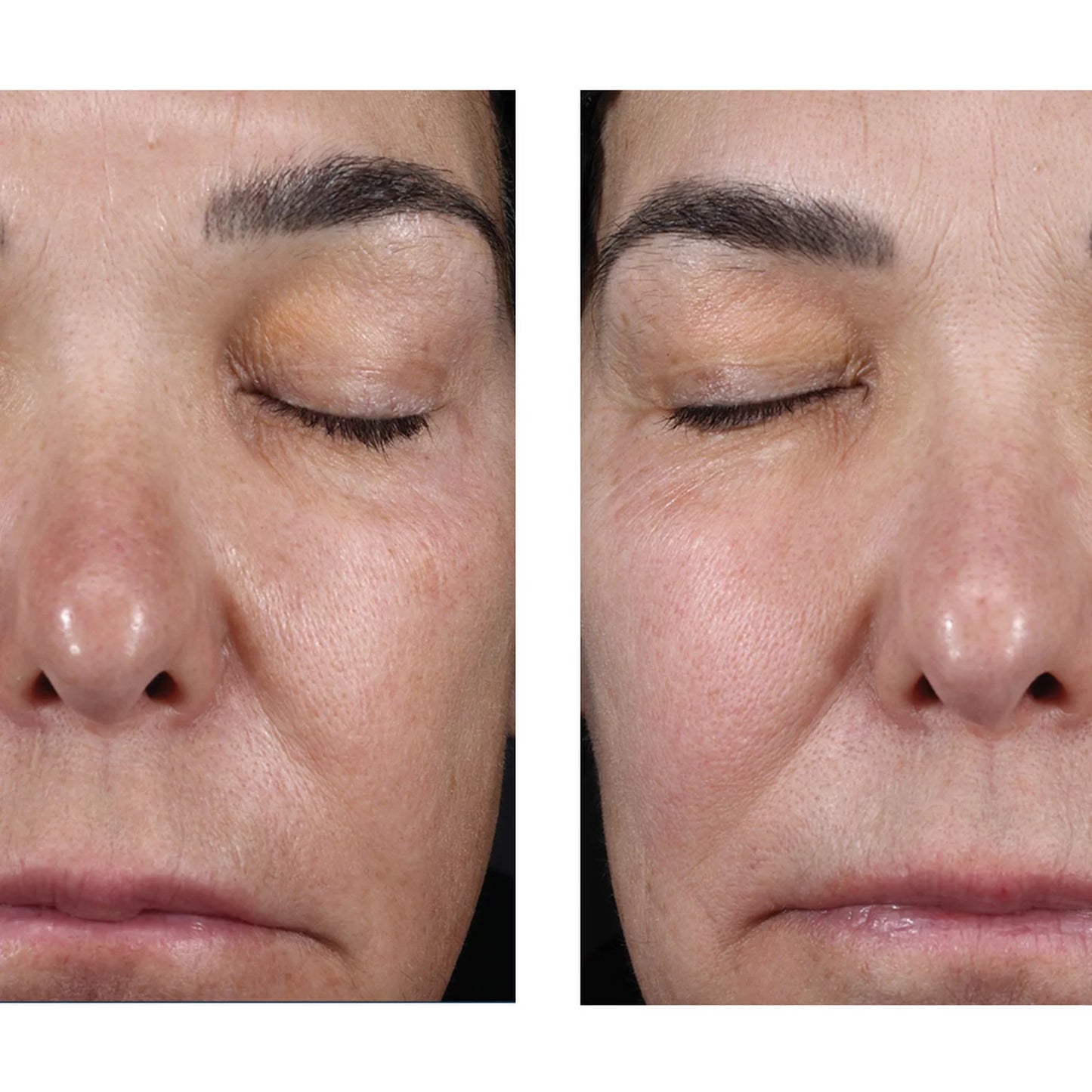 A side-by-side close-up facial comparison showing the same person's nose, eyes, cheeks, and mouth area before and after treatment, with the right side appearing smoother and more relaxed.