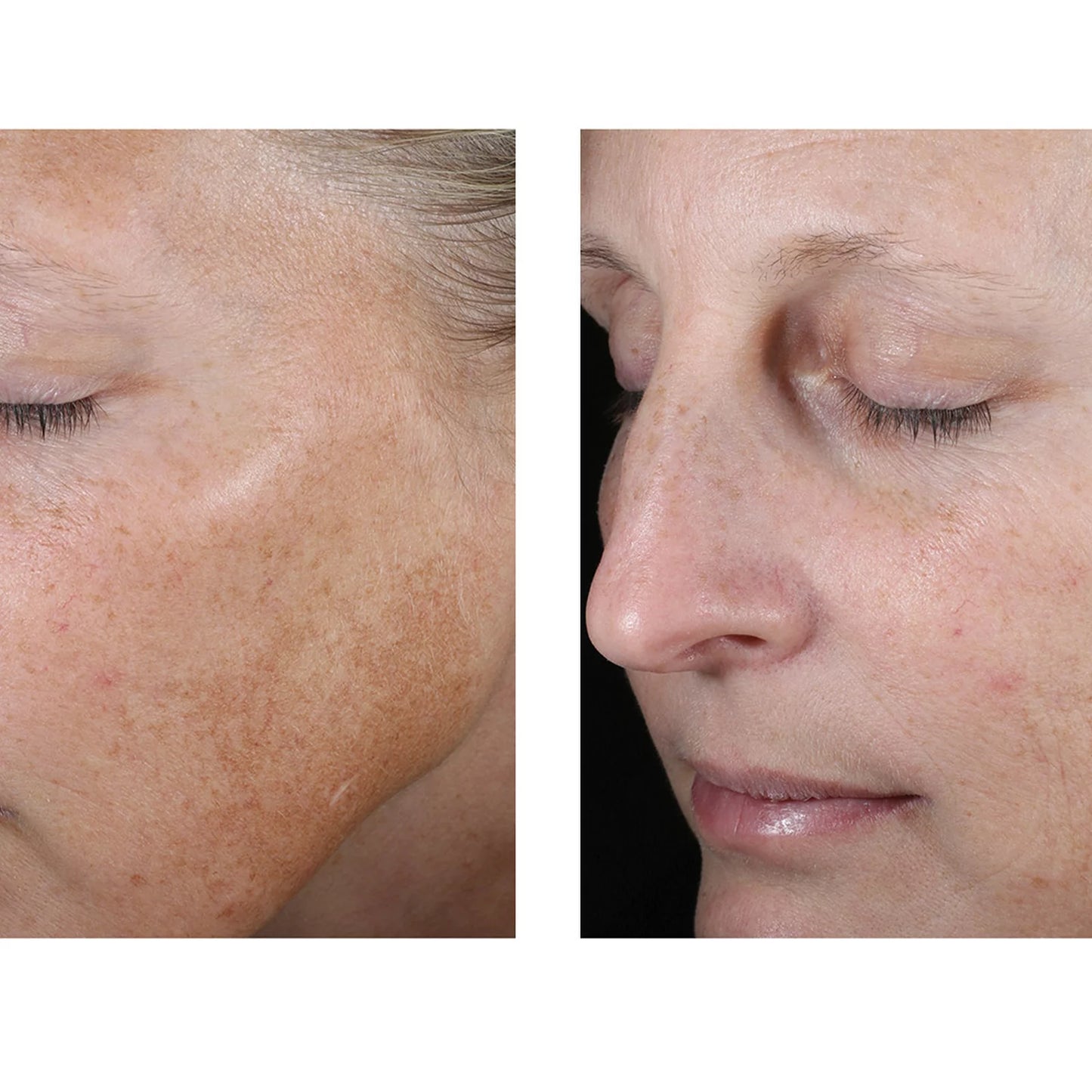 Before-and-after close-up comparison of a woman's cheek and nose area, showing a visible reduction in sun damage, freckles, and age spots on the right side.