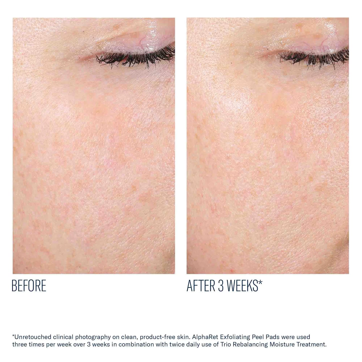 Before-and-after skin comparison showing the eye and cheek area of a person after 3 weeks of use, with visible texture improvement and reduced redness. Text at the bottom references AlphaRet Exfoliating Peel Pads and Triobalancing Moisture Treatment.