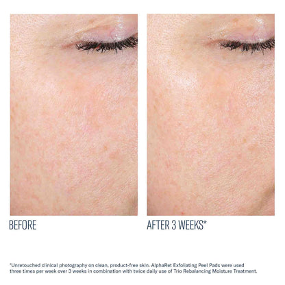 Before-and-after skin comparison showing the eye and cheek area of a person after 3 weeks of use, with visible texture improvement and reduced redness. Text at the bottom references AlphaRet Exfoliating Peel Pads and Triobalancing Moisture Treatment.