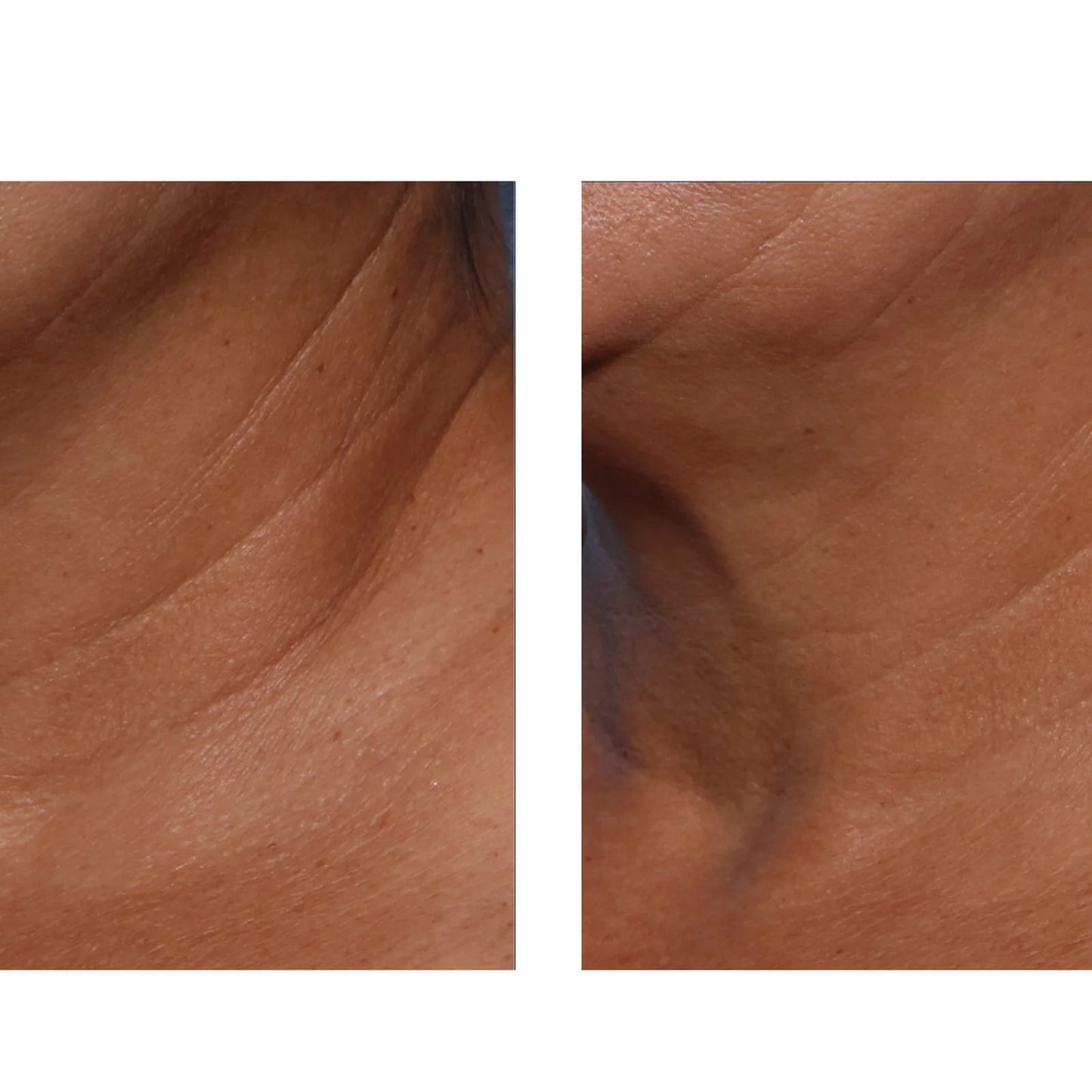 A side-by-side close-up comparison of skin texture and creasing on a person's neck, with the left side showing more visible wrinkles and the right side appearing smoother.