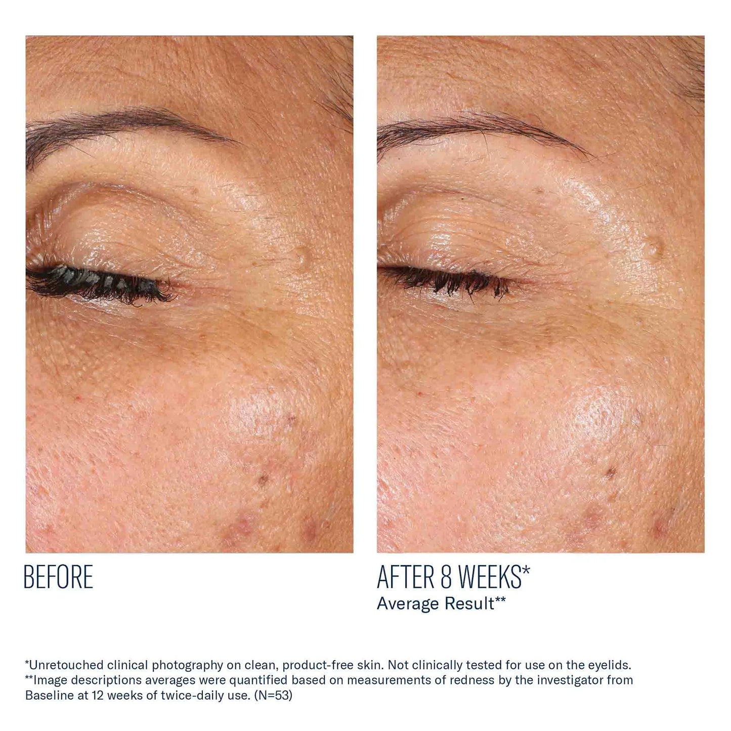 Before and after comparison of eye area skin texture on a person's eyelid.
