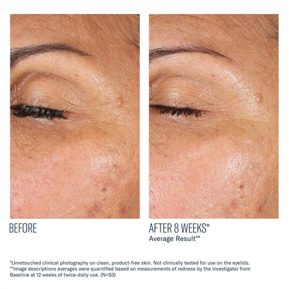 Before and after comparison of eye area skin texture on a person's eyelid.
