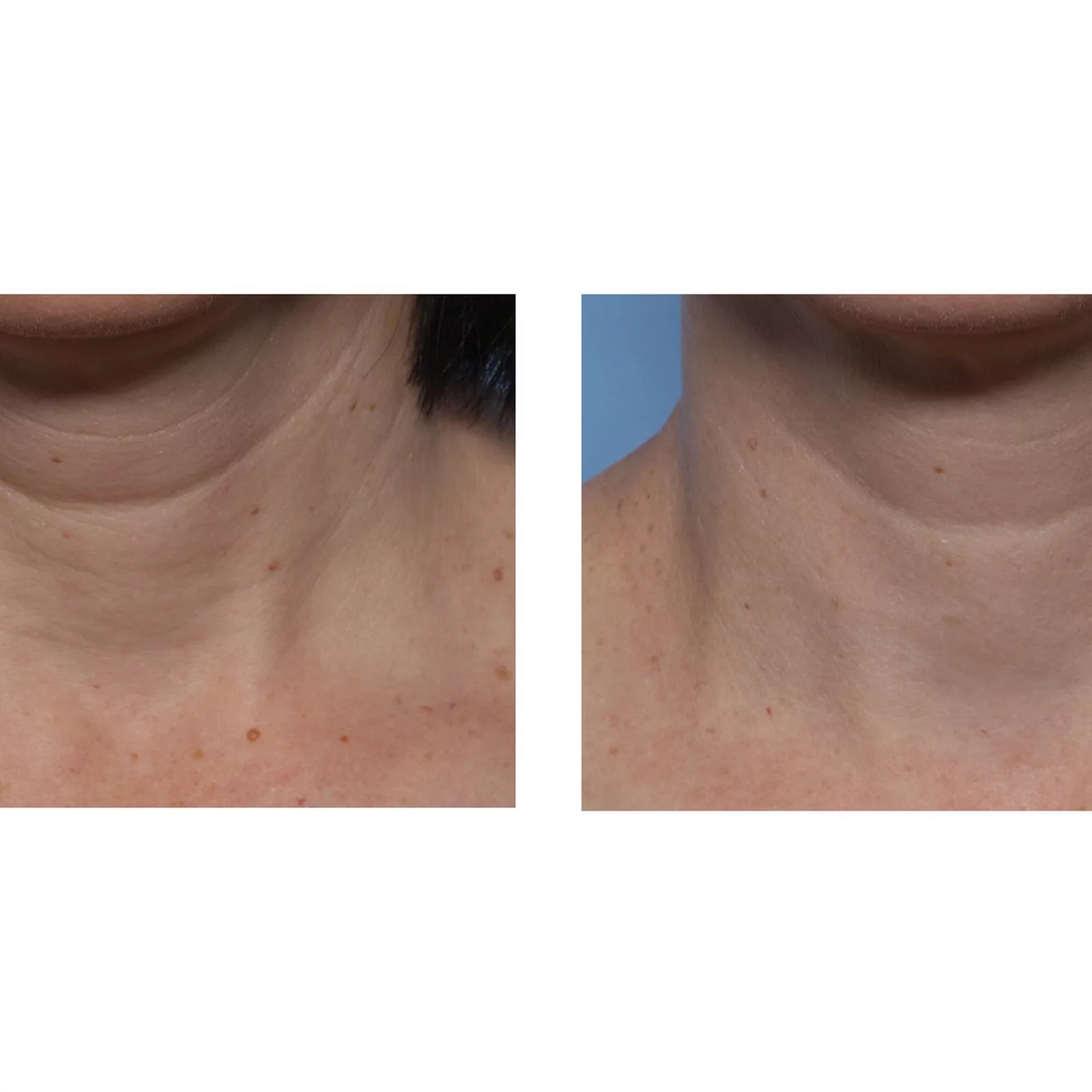 Before-and-after side-by-side comparison of a person's neck area, showing skin texture and wrinkle improvement.