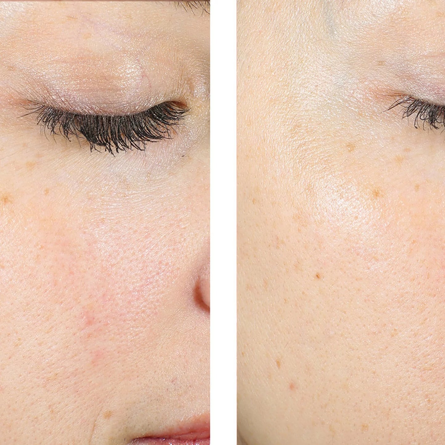 Close-up before-and-after comparison of a person's eye and cheek area, showing skin texture and appearance with and without makeup or cosmetic treatment.