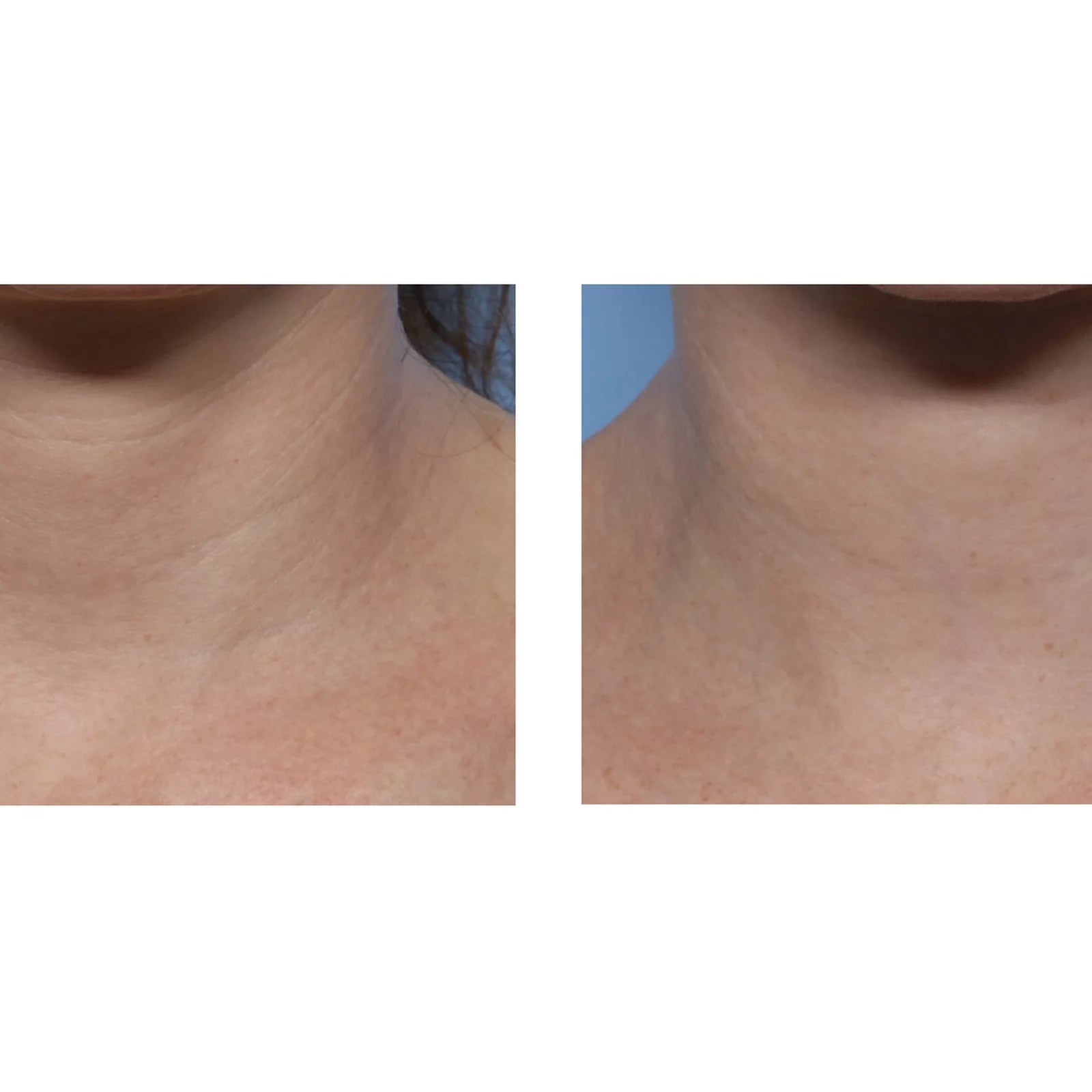 A side-by-side close-up comparison of a person's neck and upper chest area, showing skin texture and tone before and after treatment.