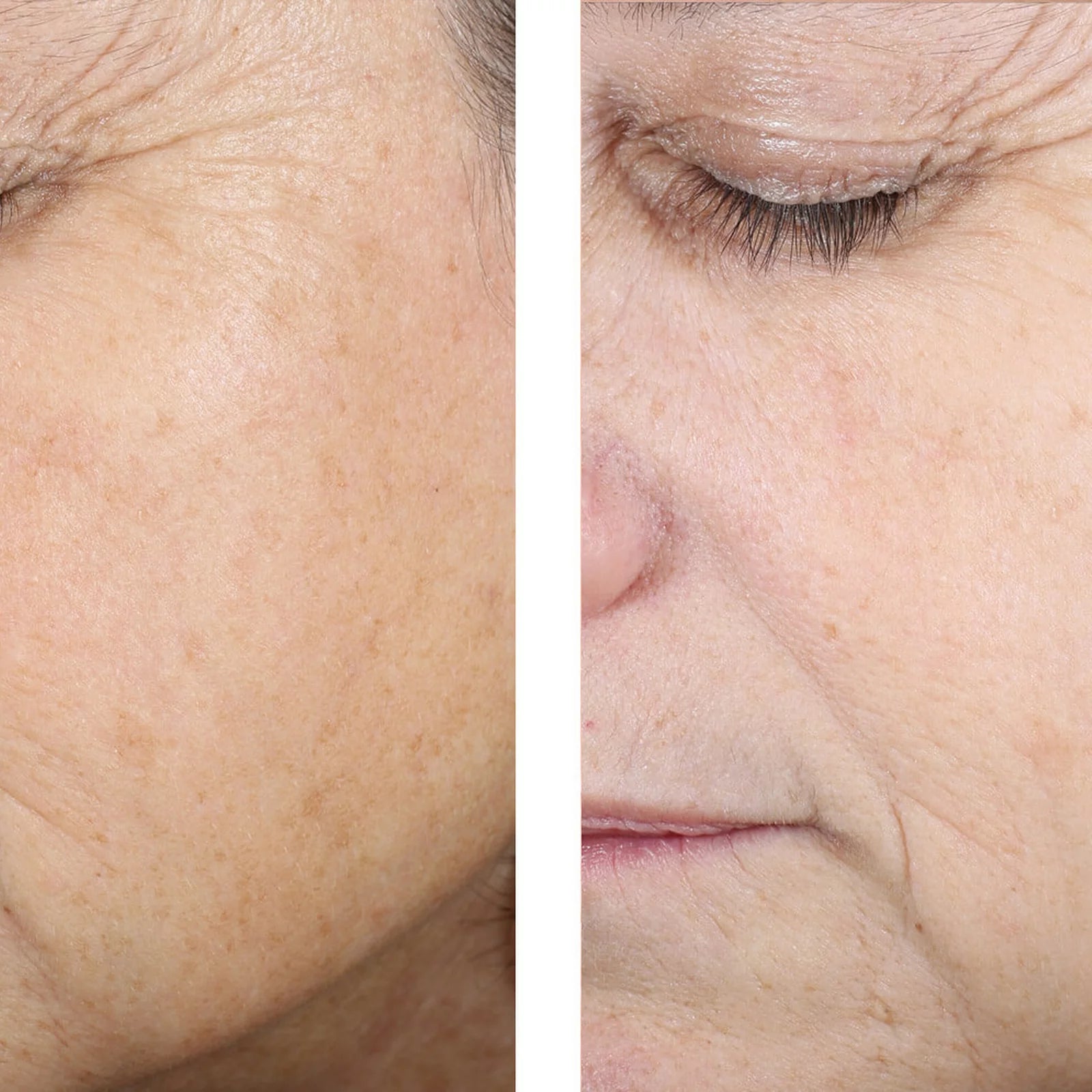 Close-up before-and-after style facial skin comparison on an older woman's cheek and eye area, showing visible texture and sun damage in the left panel and smoother, clearer skin in the right panel.