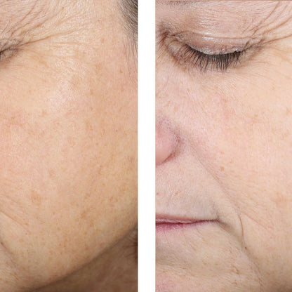 Close-up before-and-after style facial skin comparison on an older woman's cheek and eye area, showing visible texture and sun damage in the left panel and smoother, clearer skin in the right panel.