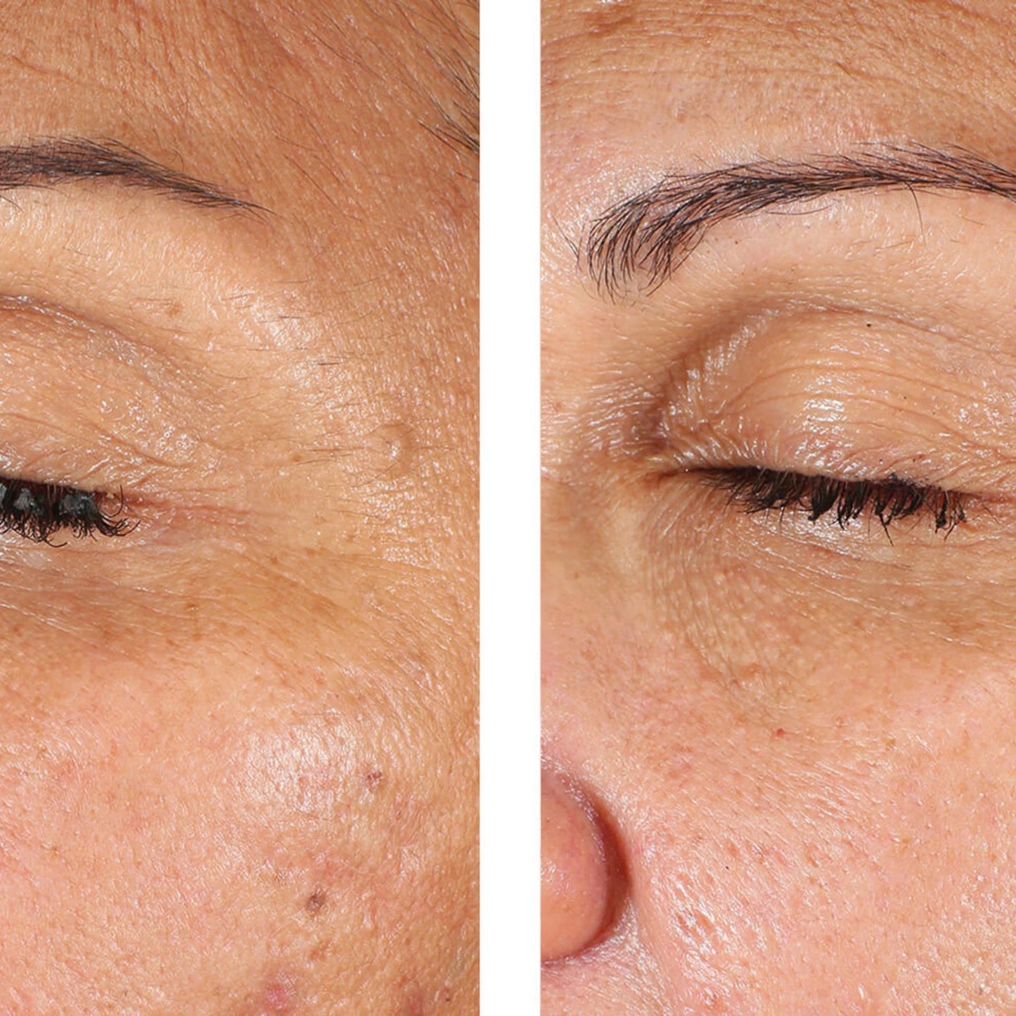 Before-and-after close-up comparison of a person's eye and surrounding facial skin, showing a visible improvement in dark under-eye circles and wrinkles.