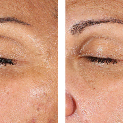 Before-and-after close-up comparison of a person's eye and surrounding facial skin, showing a visible improvement in dark under-eye circles and wrinkles.
