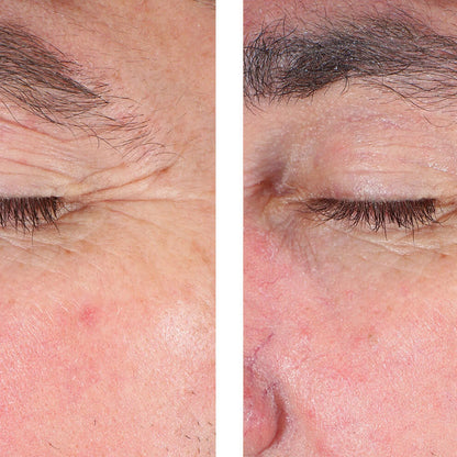 A side-by-side close-up comparison of an older person's eye and surrounding facial skin, showing wrinkles and skin texture in both panels separated by a white vertical divider.