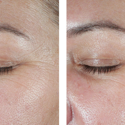 A close-up before-and-after comparison of a person's eye area, showing skin texture and wrinkles around the eyebrow and cheek in the left panel and smoother, more refined skin in the right panel.