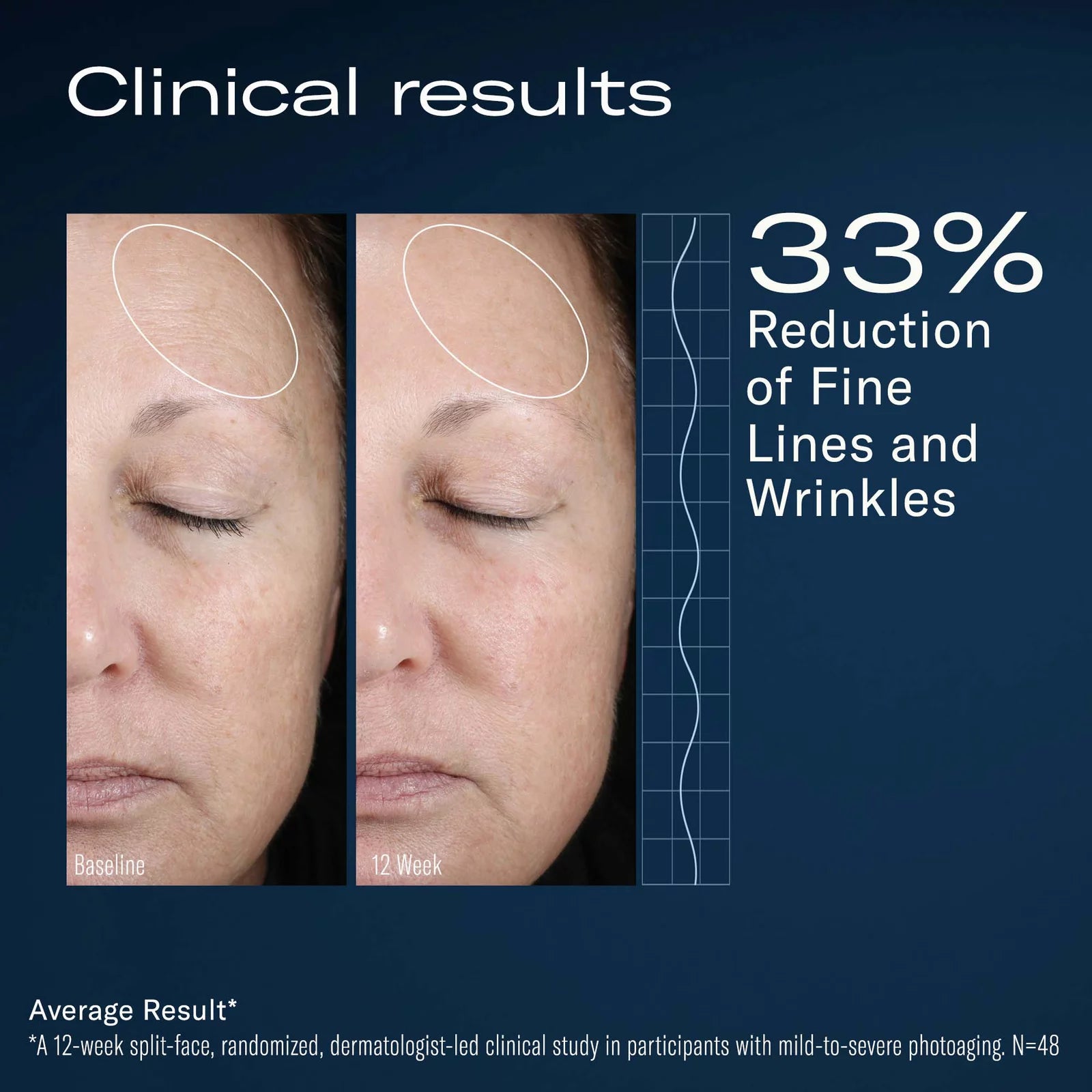 Before and after comparison of facial lines and wrinkles with clinical result text on a blue background