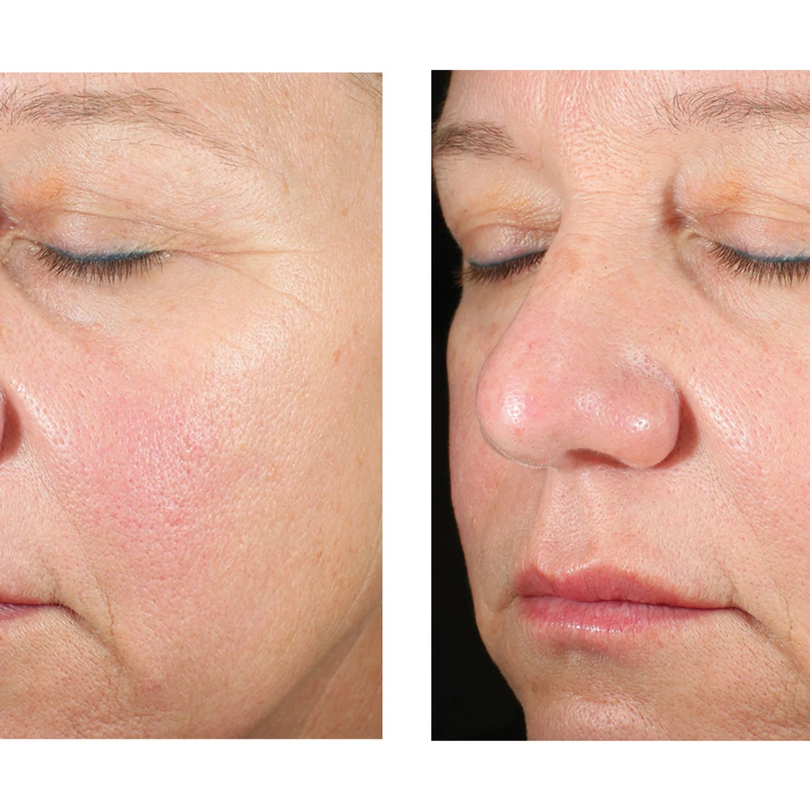 Before-and-after close-up facial comparison of a woman's face, showing skin texture and appearance on the left and smoother, clearer skin on the right.