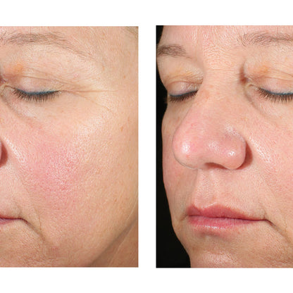 Before-and-after close-up facial comparison of a woman's face, showing skin texture and appearance on the left and smoother, clearer skin on the right.