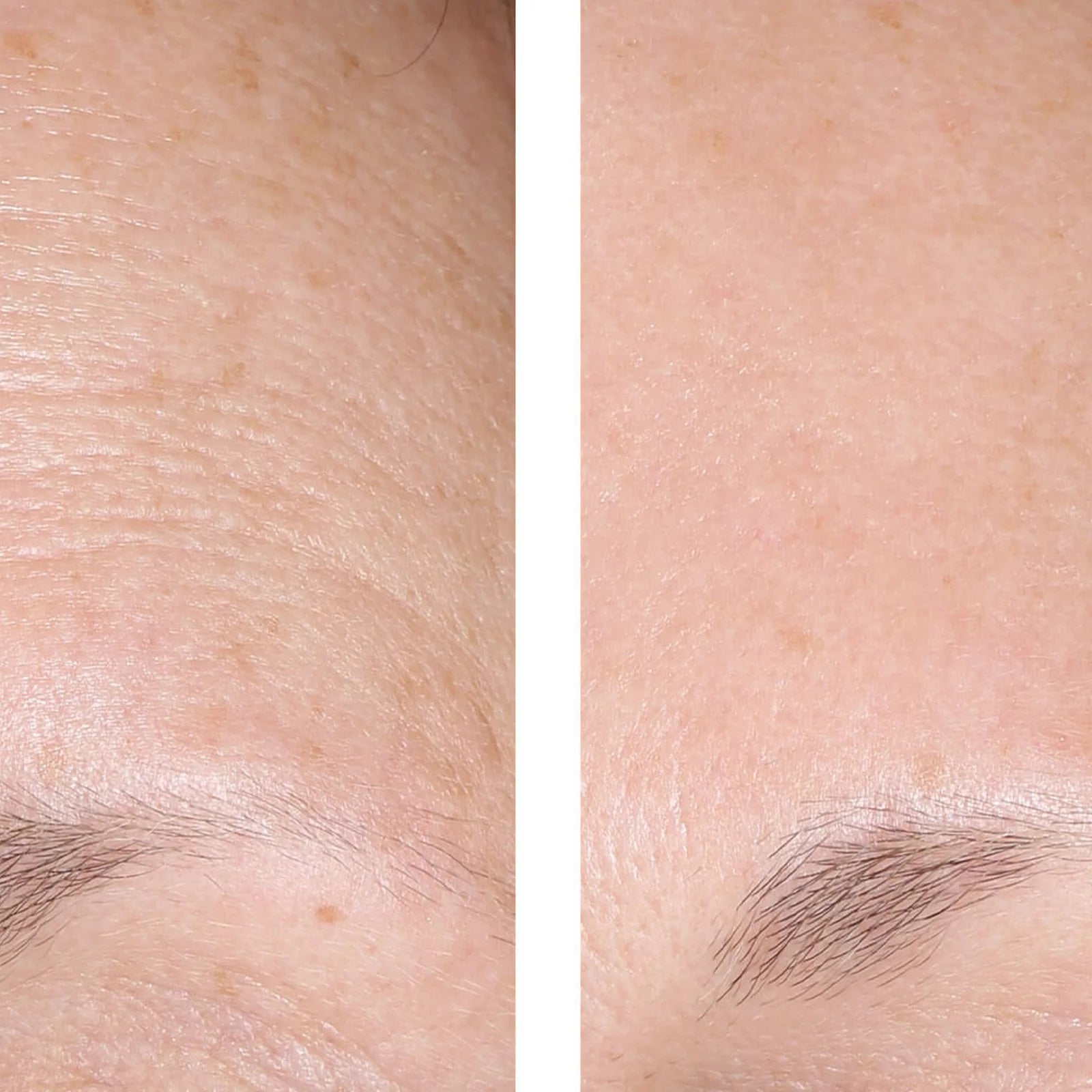 A close-up before-and-after comparison of eyebrow hair density and skin texture around the eyebrow area.
