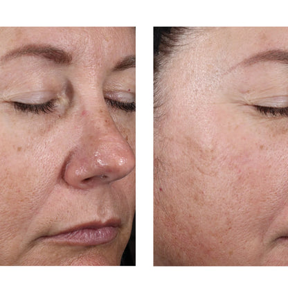 Before-and-after close-up comparison of a woman's face, showing skin texture and wrinkle improvement on the right side.