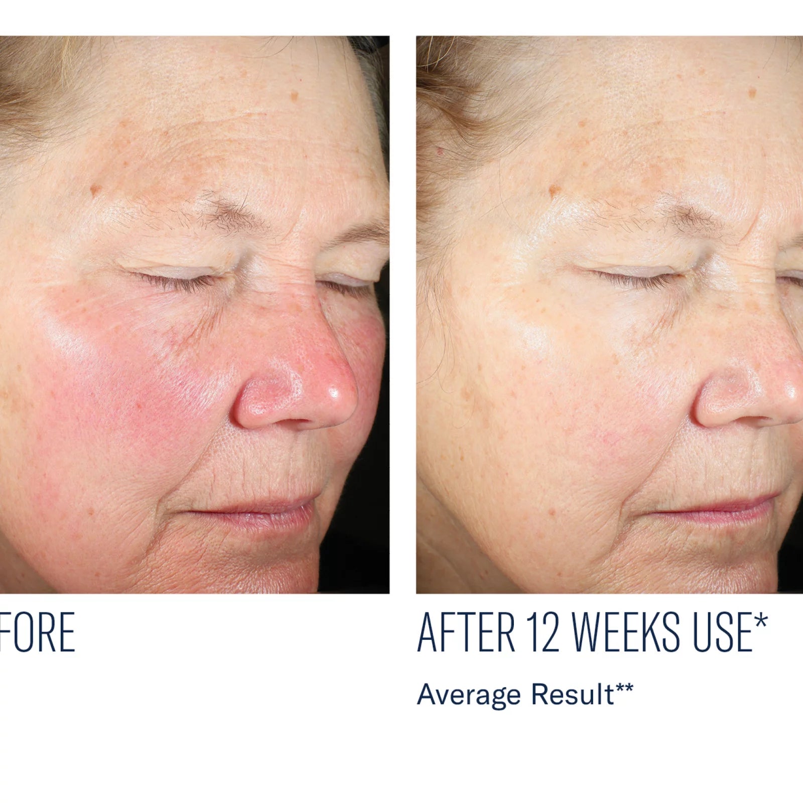 Before-and-after facial skin comparison of a woman's face, showing redness and texture improvement after 12 weeks of use.