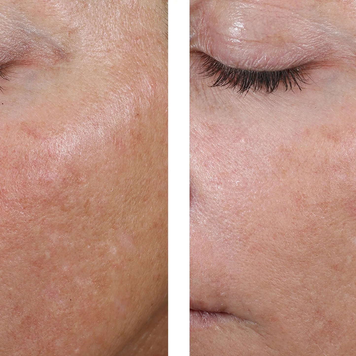 Close-up side-by-side comparison of a person's cheek and eye area, showing skin texture and appearance before and after treatment.