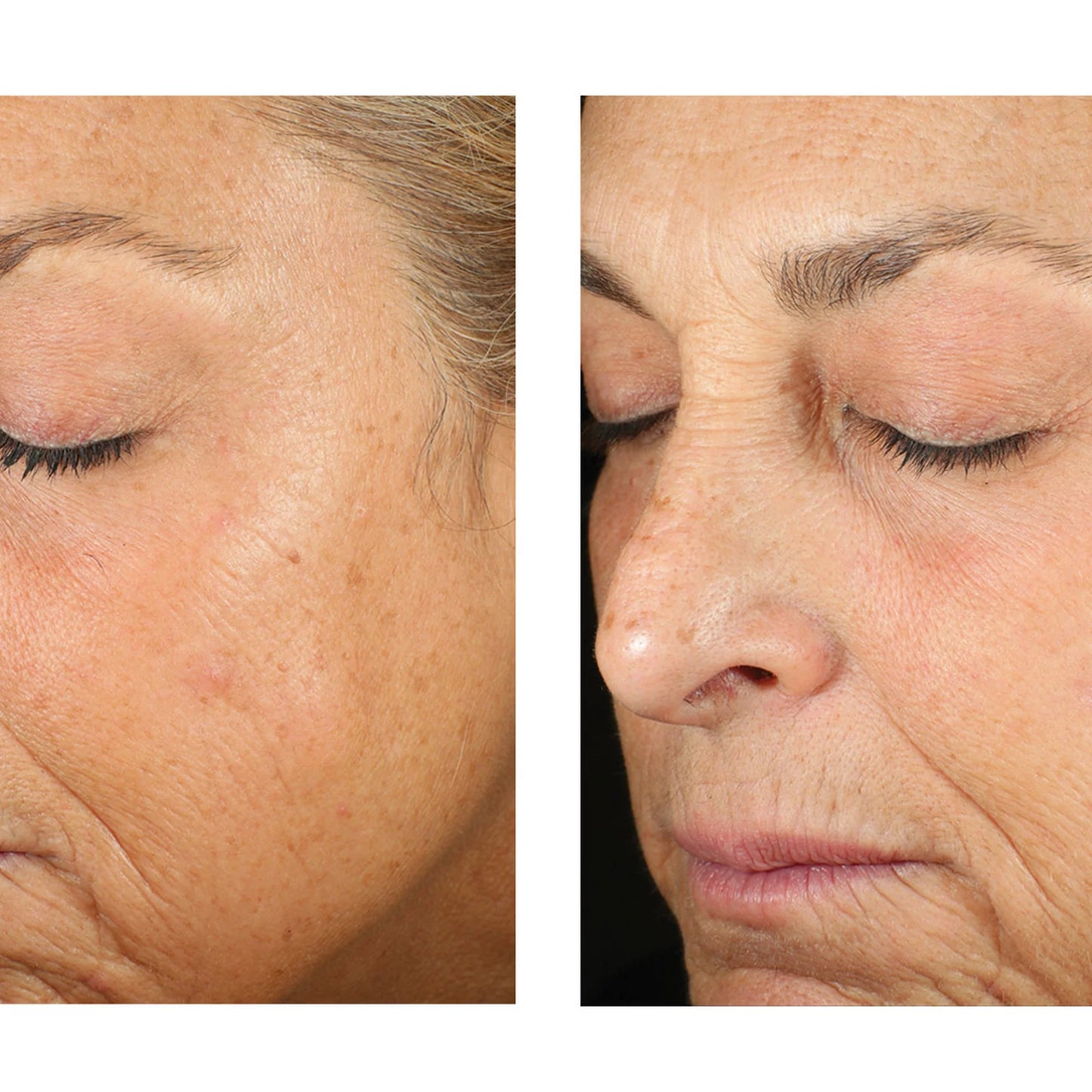 Before-and-after close-up comparison of an older woman's face, showing skin texture and wrinkle improvement on the right side.