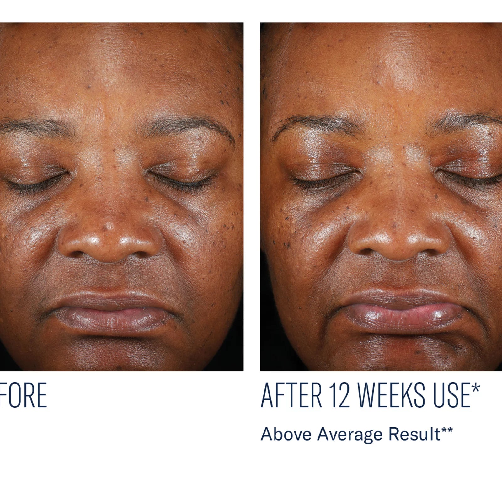 Before-and-after facial skin comparison of a Black woman's face, showing skin texture and tone improvement after 12 weeks of use, with text reading 'AFTER 12 WEEKS USE* Above Average Result**'.