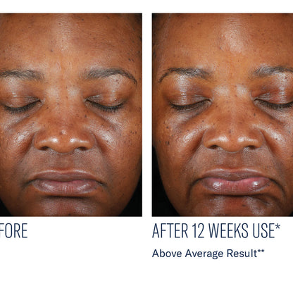 Before-and-after facial skin comparison of a Black woman's face, showing skin texture and tone improvement after 12 weeks of use, with text reading 'AFTER 12 WEEKS USE* Above Average Result**'.
