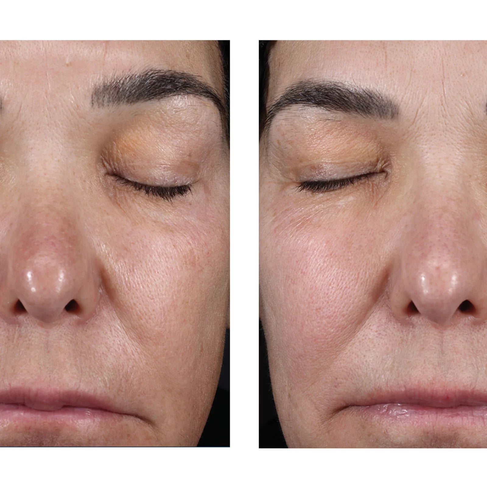 A side-by-side close-up facial comparison showing the same person's nose, eyes, cheeks, and mouth area before and after treatment, with the right side appearing smoother and more relaxed.