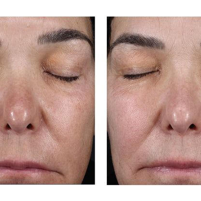 A side-by-side close-up facial comparison showing the same person's nose, eyes, cheeks, and mouth area before and after treatment, with the right side appearing smoother and more relaxed.